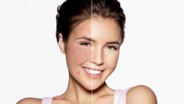 How to Edit Redness on Face on Iphone
